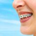 Metode Solvosis, Alternatif Untuk Pembersihan Behel Gigi